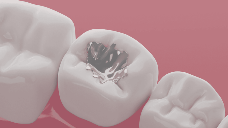 Why Single Sitting Root Canal
