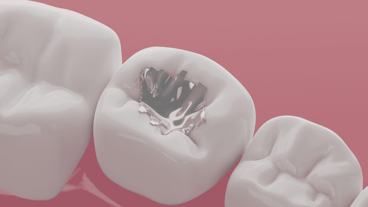 Why Single Sitting Root Canal